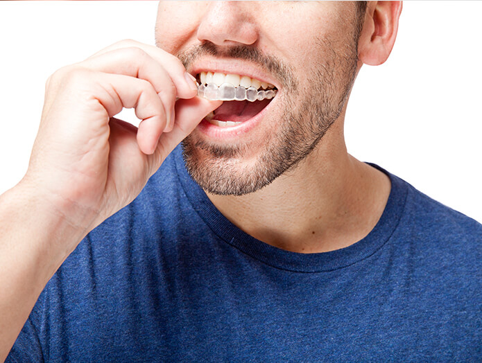man inserting a clear aligner onto his teeth