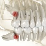 digital image of impacted wisdom teeth