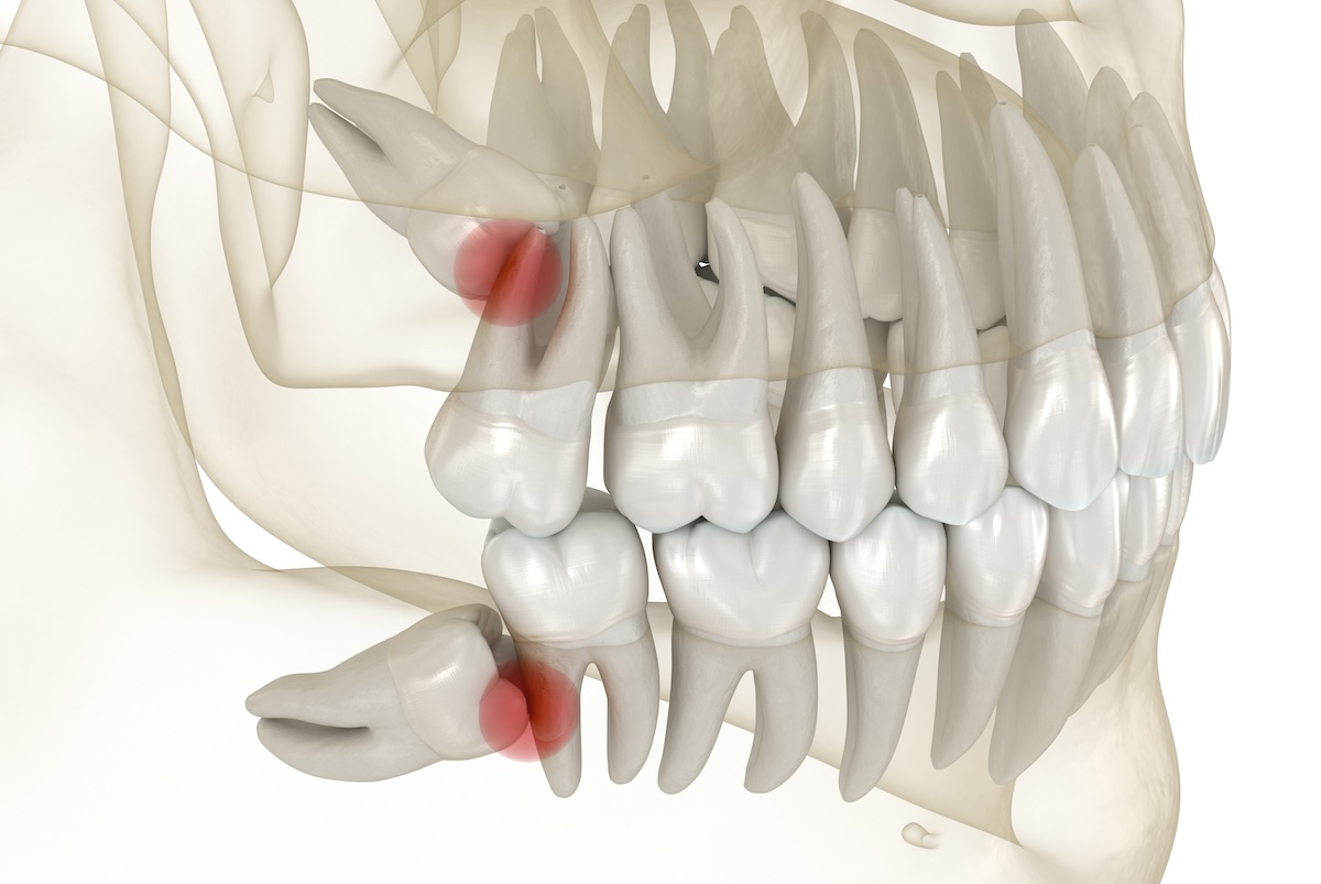 digital image of impacted wisdom teeth