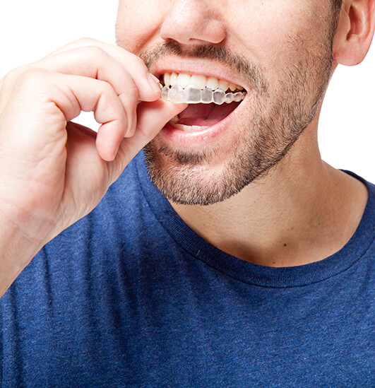 man inserting clear aligner onto his teeth